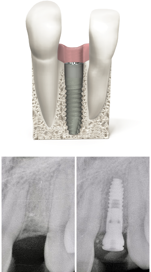 Tapered 3.0 dental implant